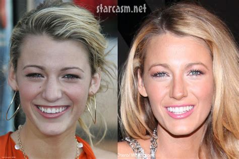 blake lively before and after plastic surgery|blake lively before nose job.